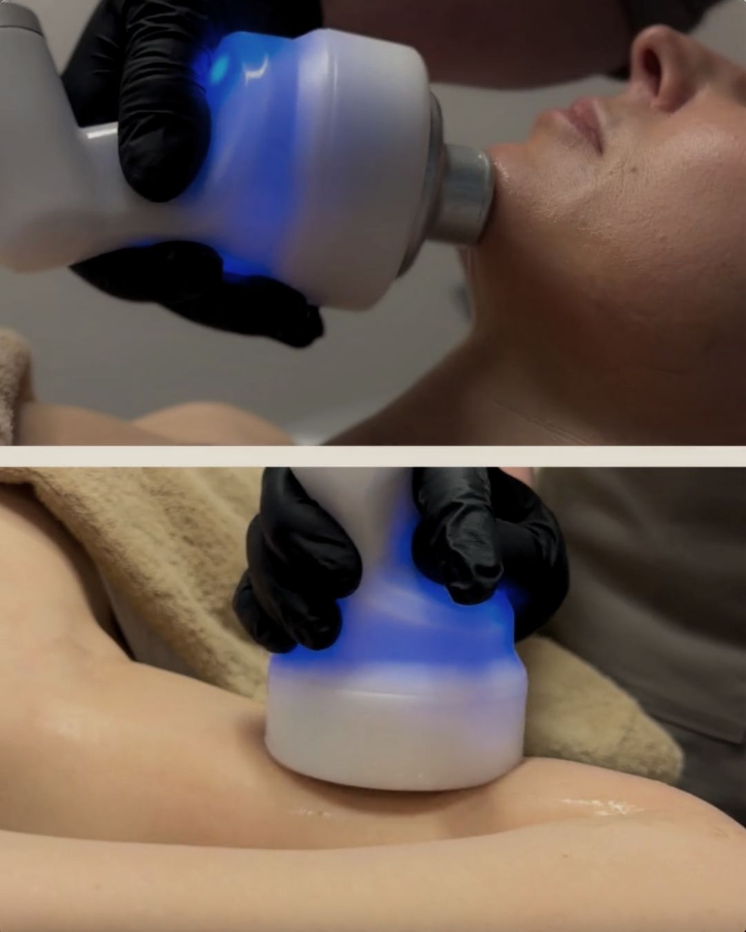 Krioterapija veidui CRYO T SHOCK